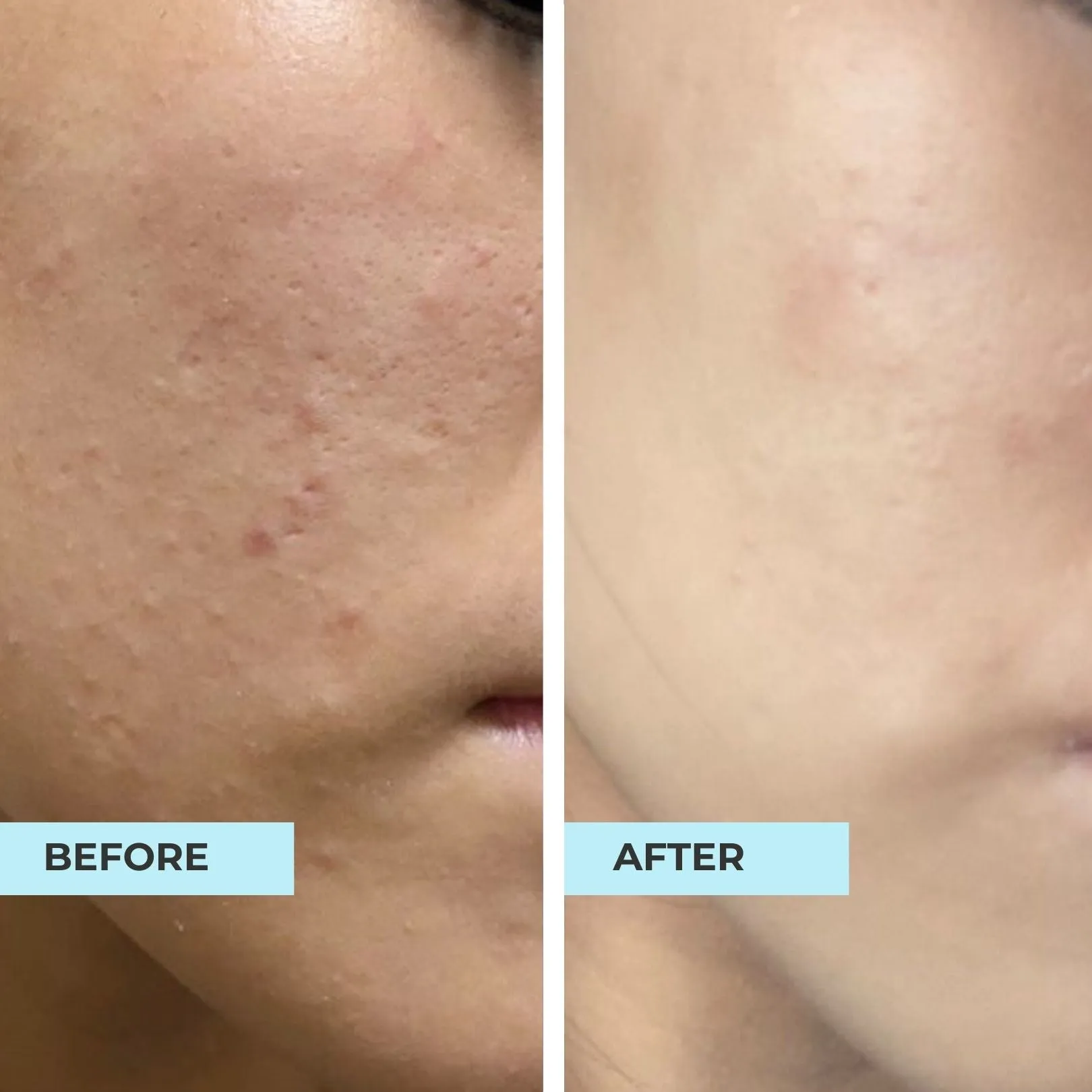 Comedones & Clogged Skin Kit