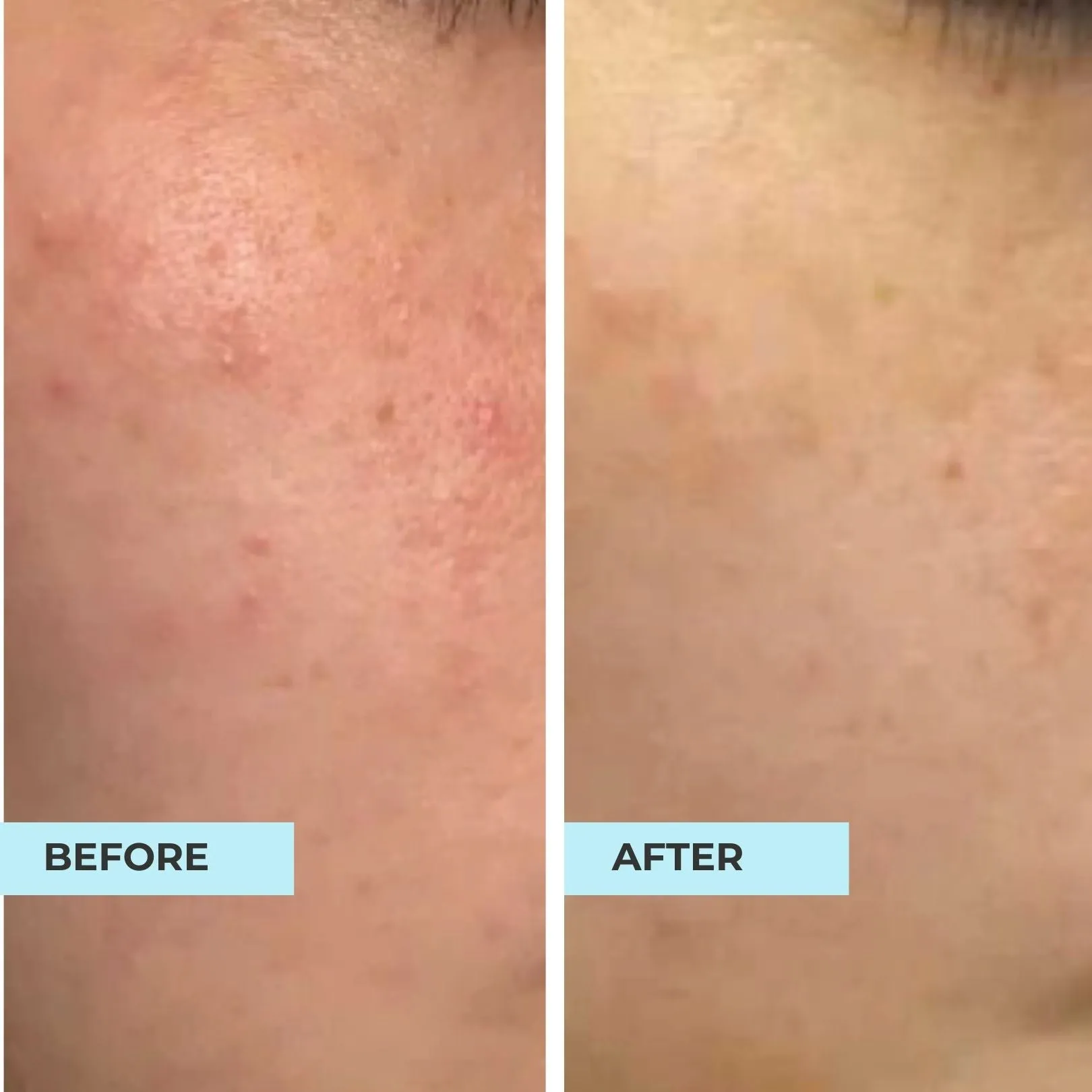 Comedones & Clogged Skin Kit