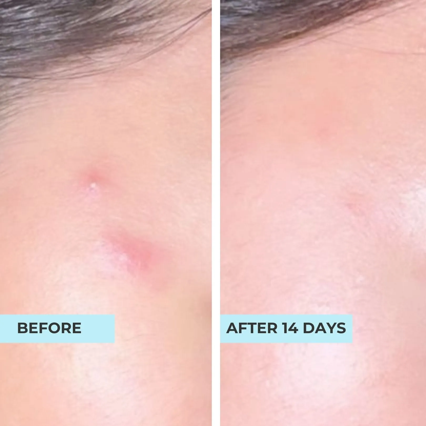 Comedones & Clogged Skin Kit