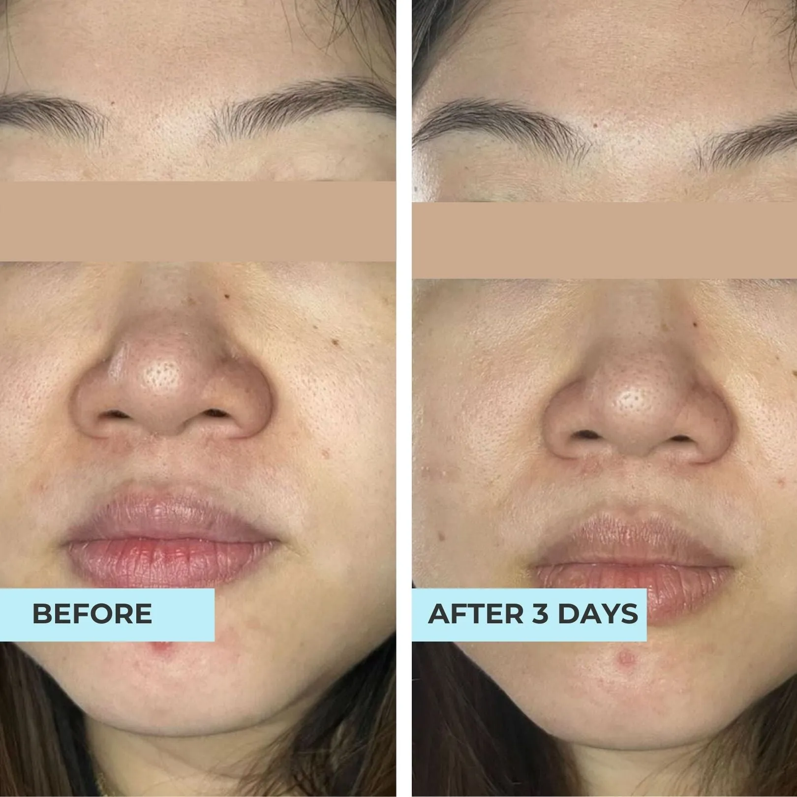 Comedones & Clogged Skin Kit
